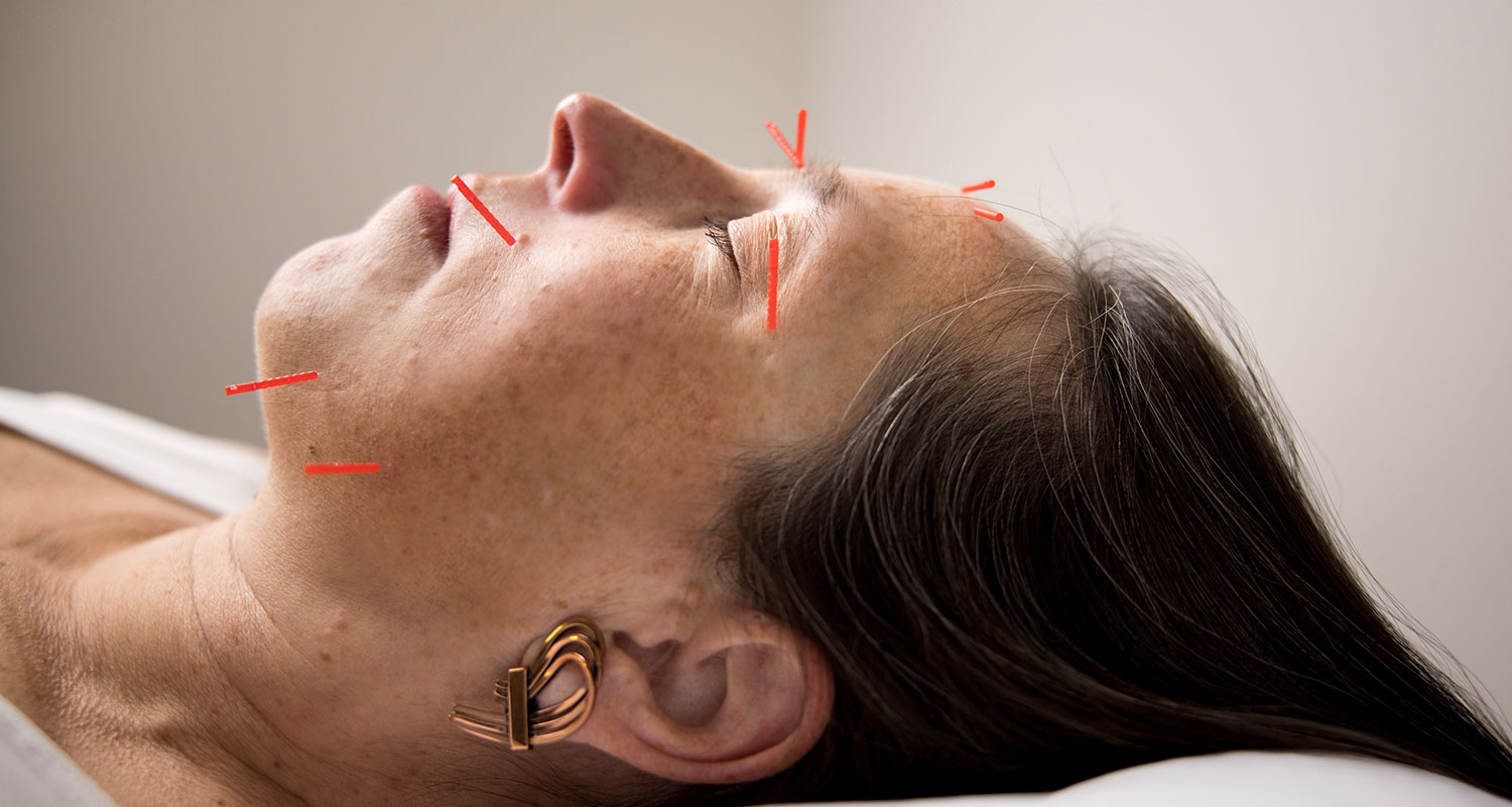 person receiving cosmetic facial acupuncture